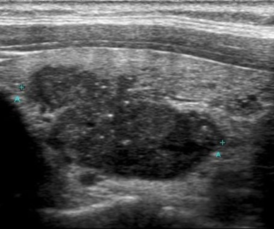 Thyroid Ultrasound For Papillary Thyroid Cancer Thyroid Ultrasound For Papillary Thyroid Cancer